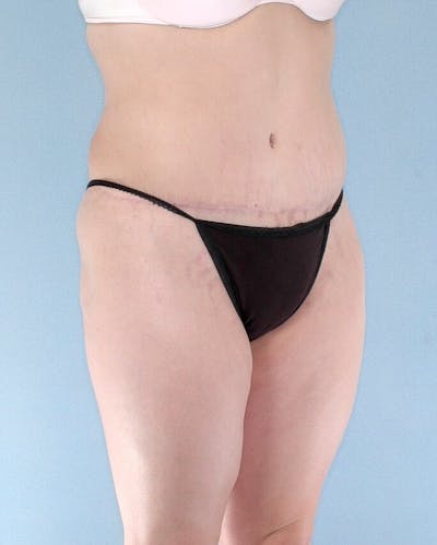 Tummy Tuck Before & After Gallery - Patient 185235 - Image 8