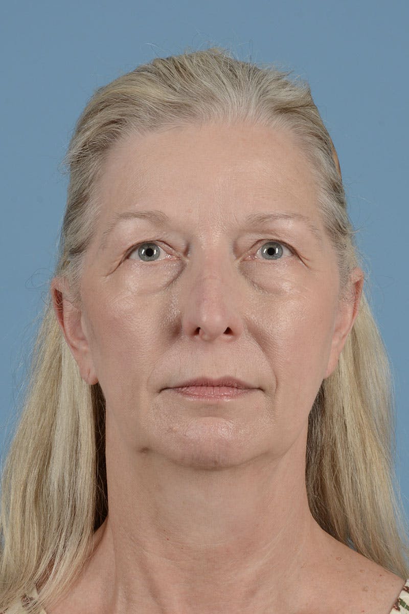 Neck Lift Before & After Gallery - Patient 825871 - Image 1