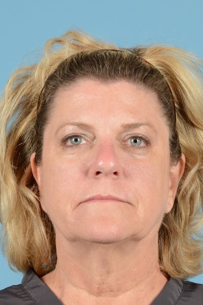 Facelift Before & After Gallery - Patient 414693 - Image 1