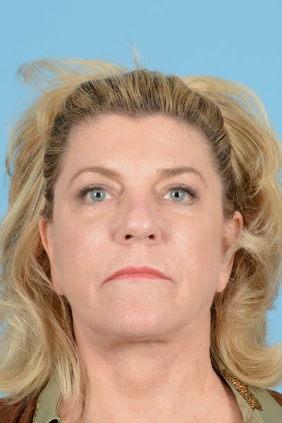 Facelift Before & After Gallery - Patient 414693 - Image 2