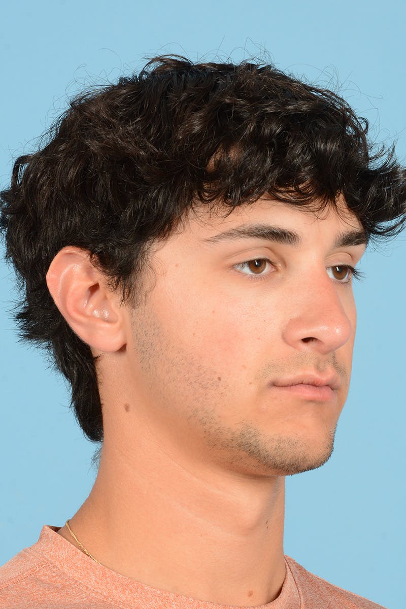 Rhinoplasty Before & After Gallery - Patient 714712 - Image 3