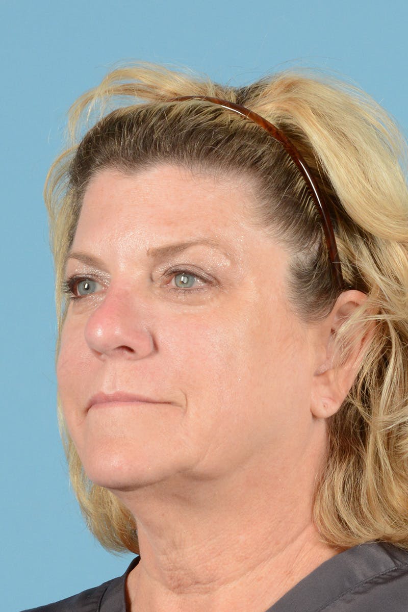 Facelift Before & After Gallery - Patient 414693 - Image 3
