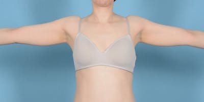 Liposuction Before & After Gallery - Patient 248003 - Image 1