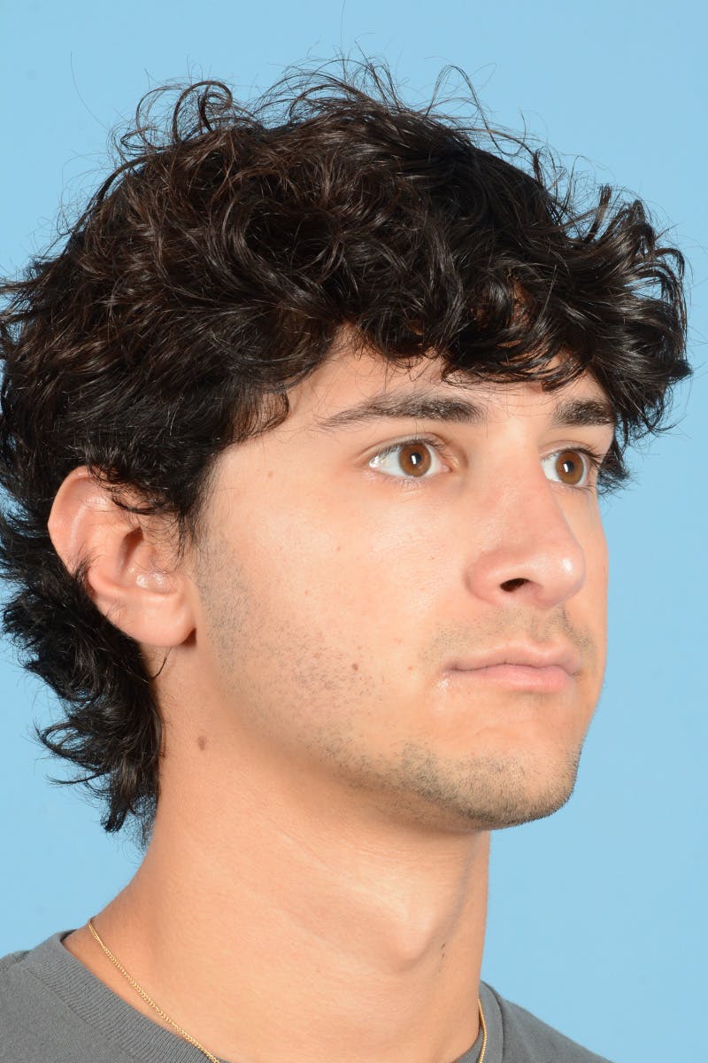 Rhinoplasty Before & After Gallery - Patient 714712 - Image 4