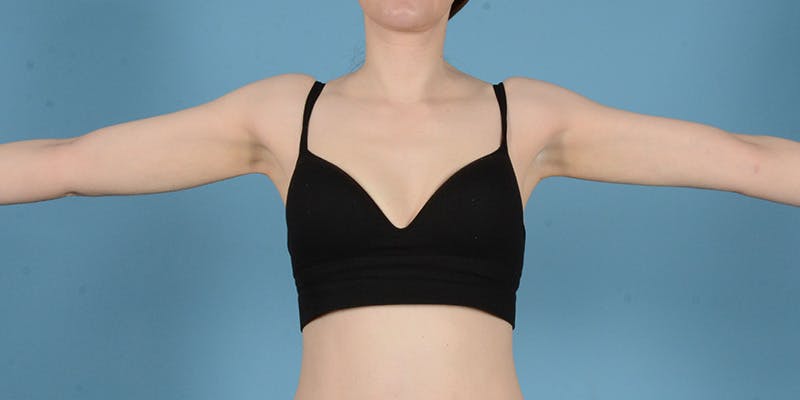 Liposuction Before & After Gallery - Patient 248003 - Image 2