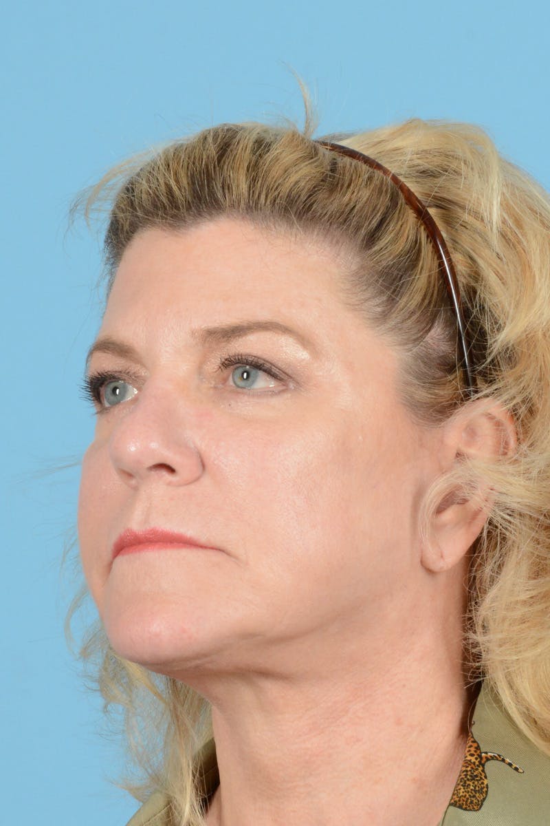 Facelift Before & After Gallery - Patient 414693 - Image 4