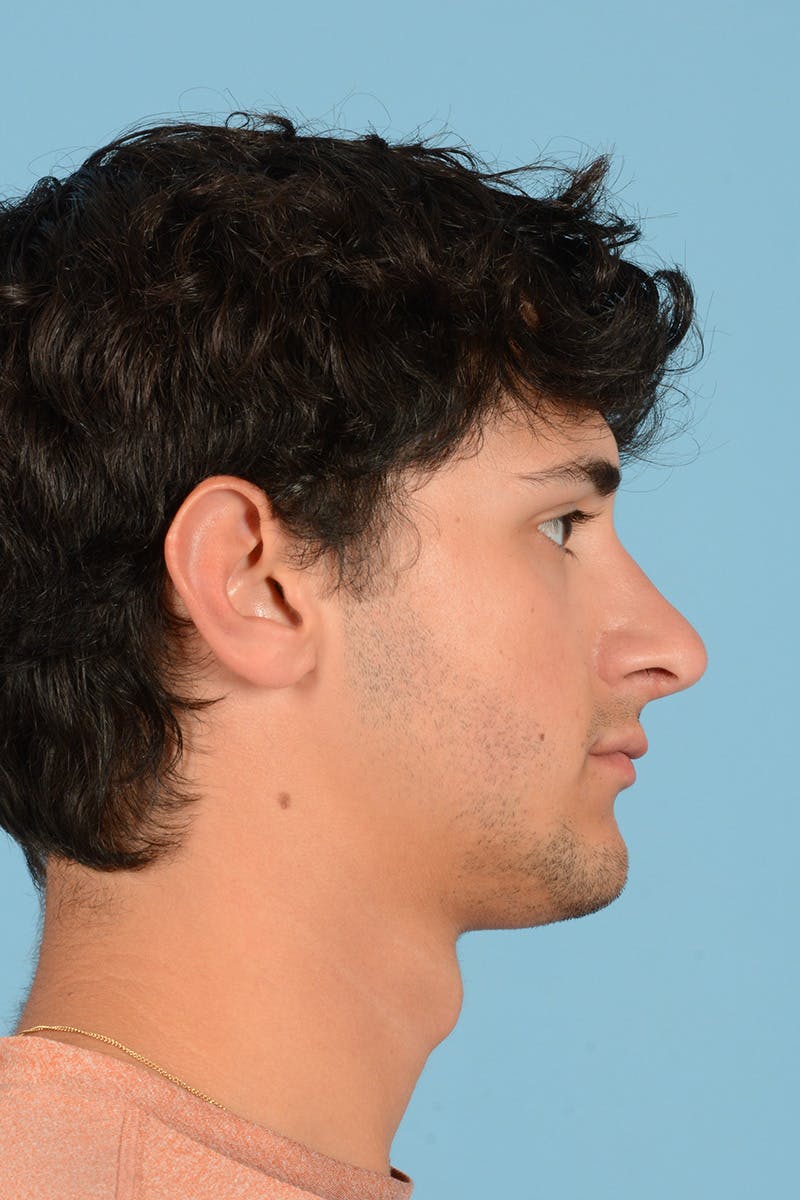 Rhinoplasty Before & After Gallery - Patient 714712 - Image 5