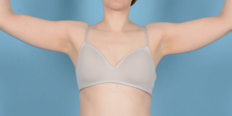 Liposuction Before & After Gallery - Patient 248003 - Image 3