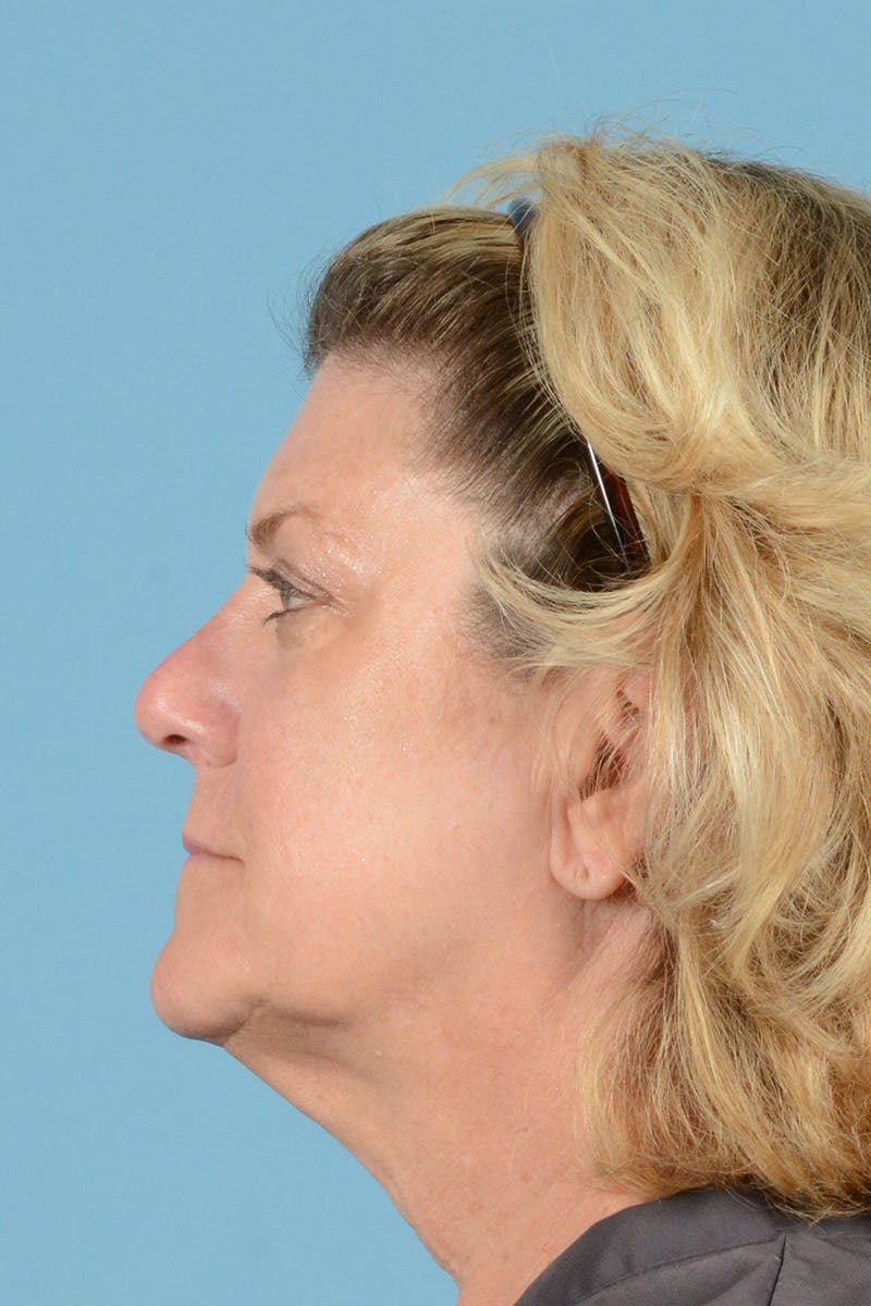 Facelift Before & After Gallery - Patient 414693 - Image 5