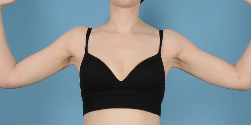 Liposuction Before & After Gallery - Patient 248003 - Image 4