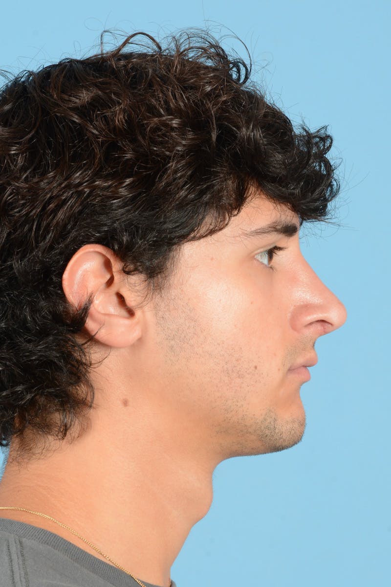 Rhinoplasty Before & After Gallery - Patient 714712 - Image 6