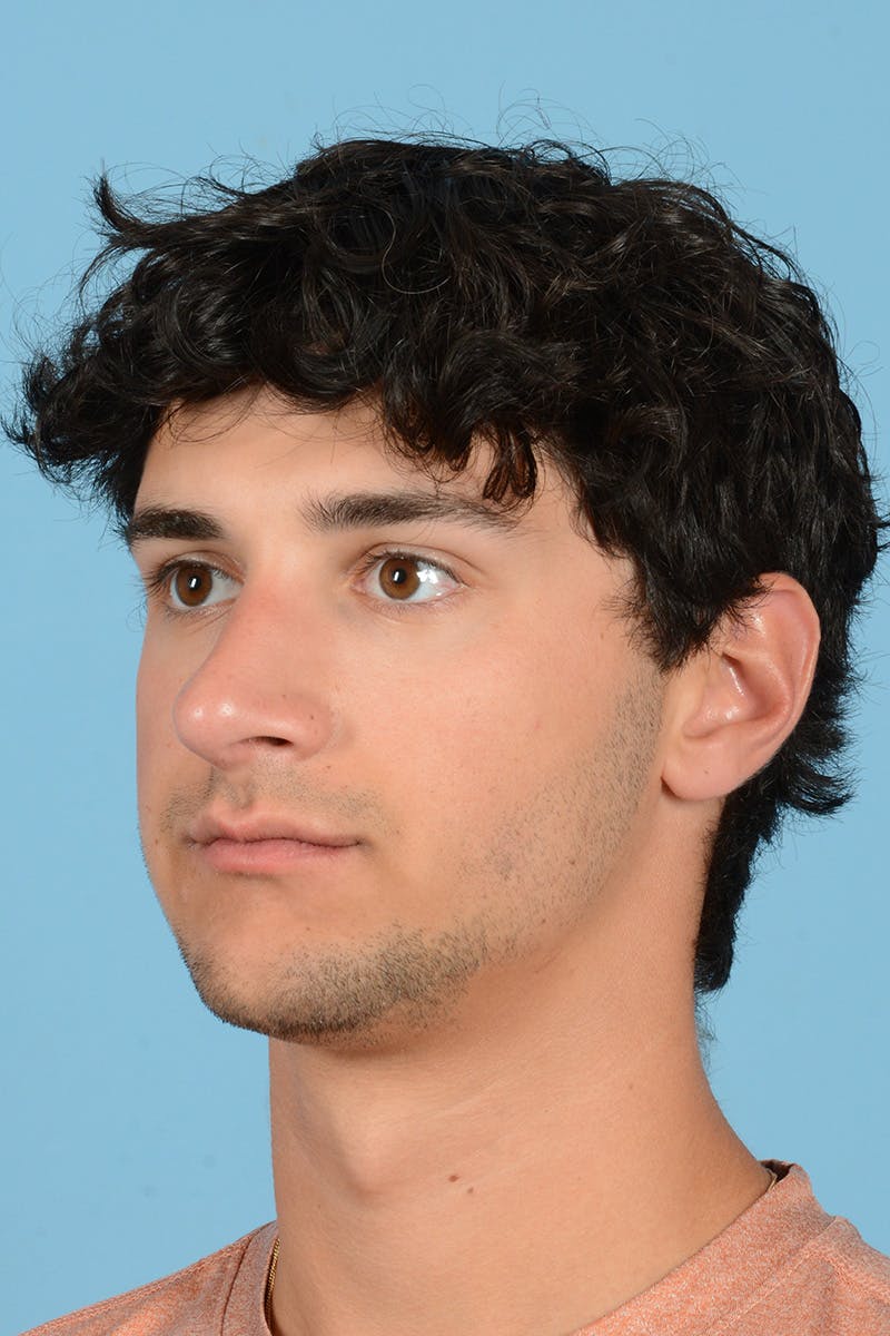 Rhinoplasty Before & After Gallery - Patient 714712 - Image 7