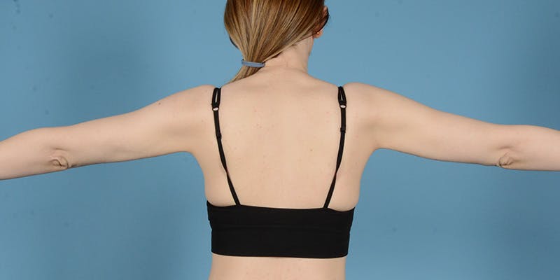 Liposuction Before & After Gallery - Patient 248003 - Image 6