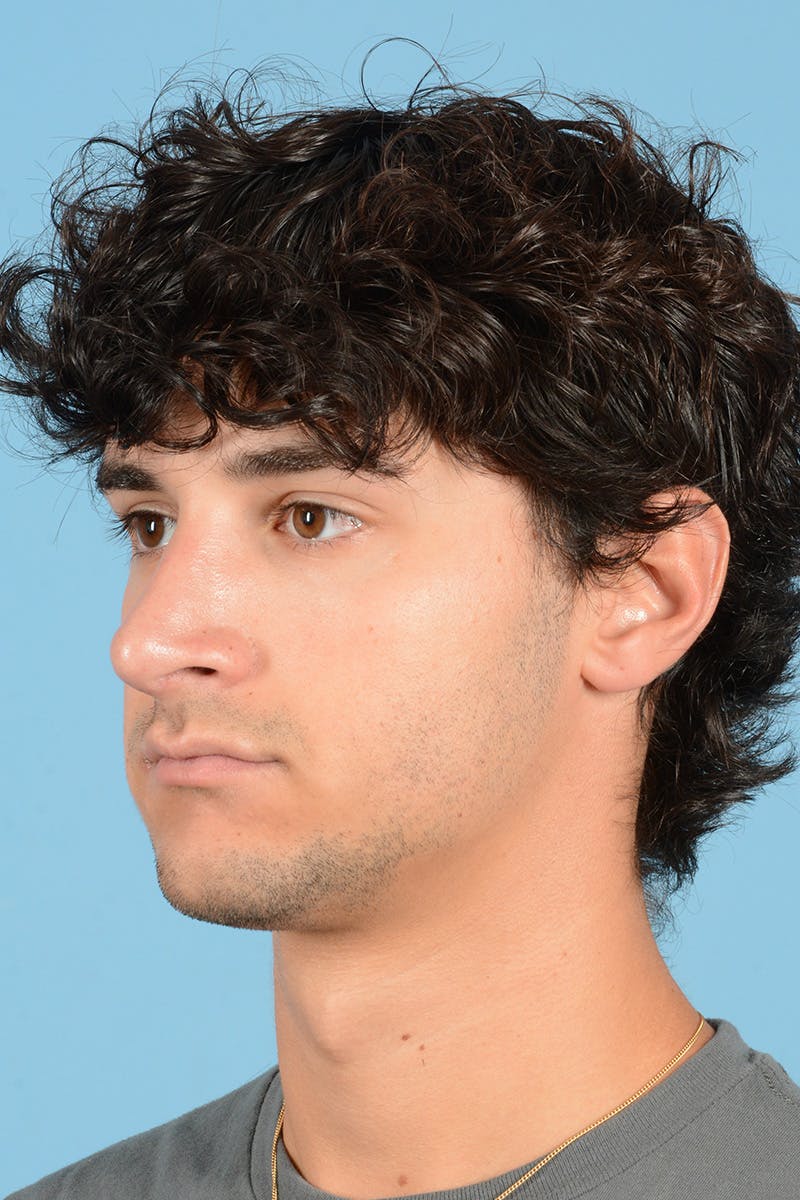 Rhinoplasty Before & After Gallery - Patient 714712 - Image 8