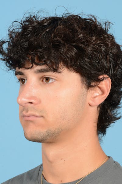 Rhinoplasty Before & After Gallery - Patient 714712 - Image 8