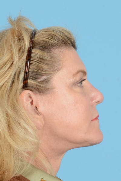 Facelift Before & After Gallery - Patient 414693 - Image 8