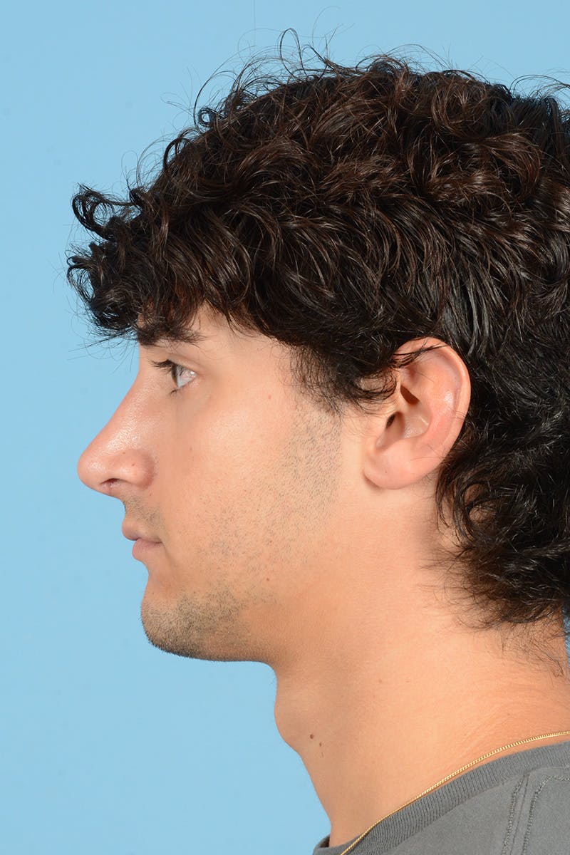 Rhinoplasty Before & After Gallery - Patient 714712 - Image 10