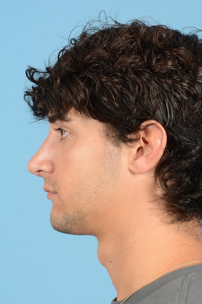 Rhinoplasty Before & After Gallery - Patient 714712 - Image 10