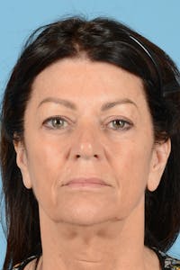 Facelift Before & After Gallery - Patient 413115 - Image 1