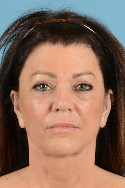 Facelift Before & After Gallery - Patient 413115 - Image 2