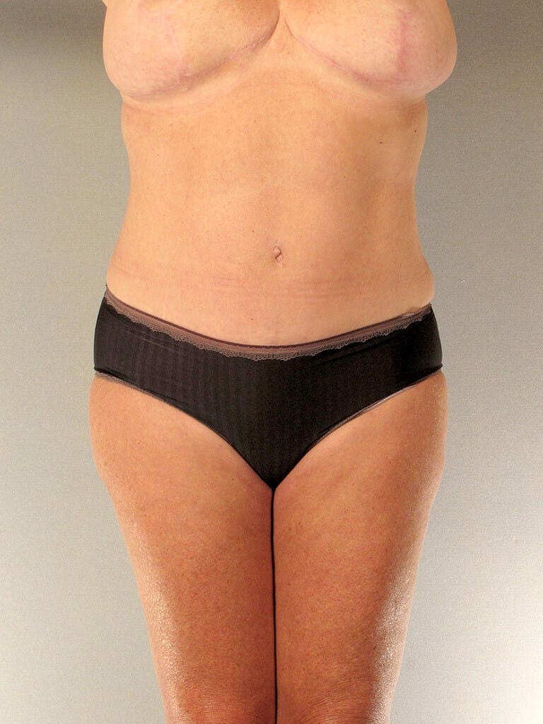 Tummy Tuck Before & After Gallery - Patient 275002 - Image 2