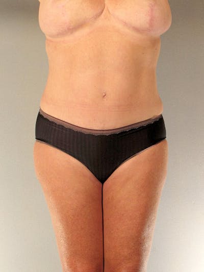 Tummy Tuck Before & After Gallery - Patient 275002 - Image 2