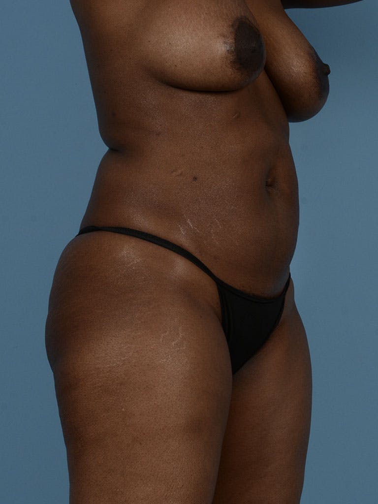 Liposuction Before & After Gallery - Patient 372540 - Image 3
