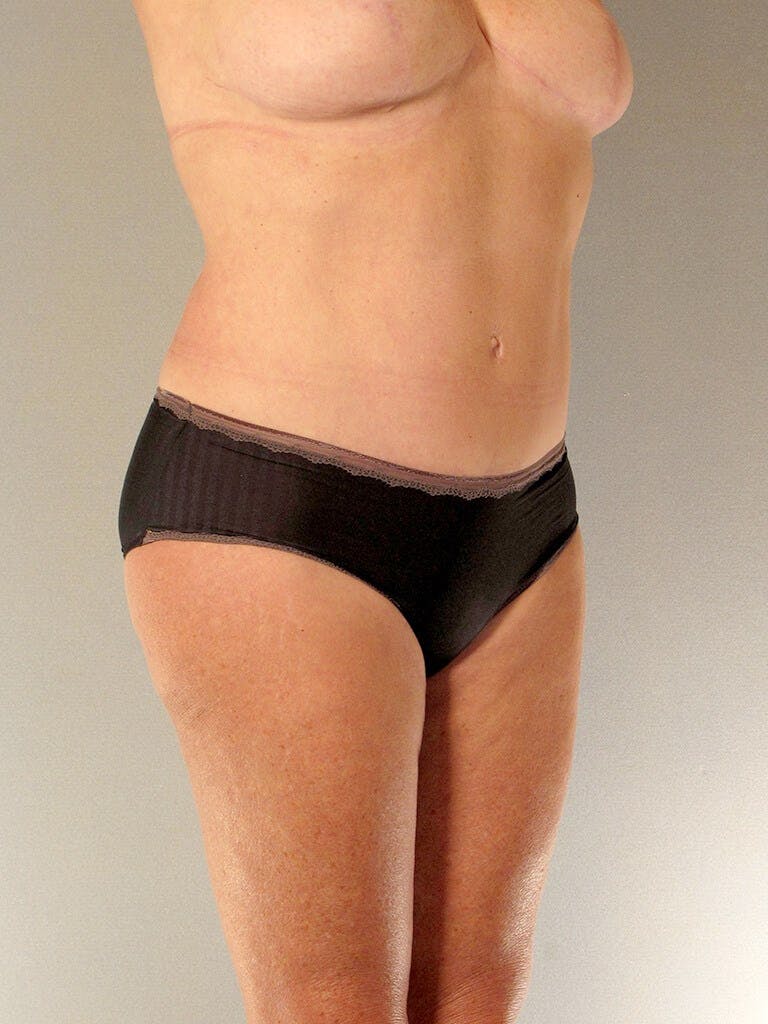 Tummy Tuck Before & After Gallery - Patient 275002 - Image 4