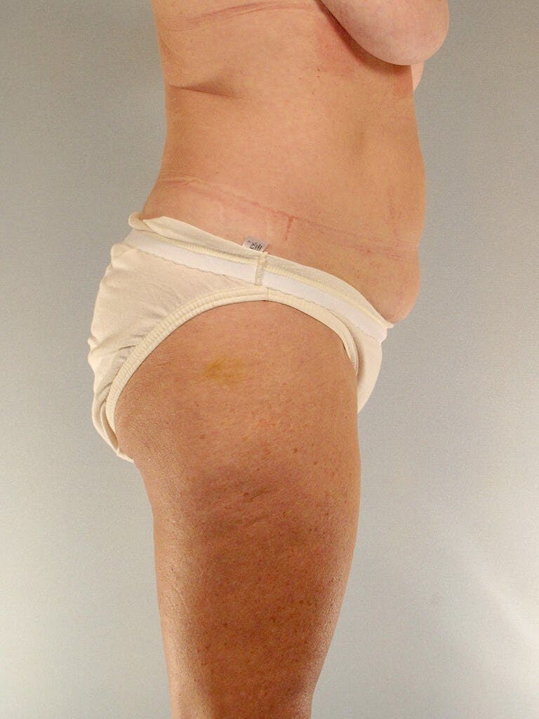 Tummy Tuck Before & After Gallery - Patient 275002 - Image 5