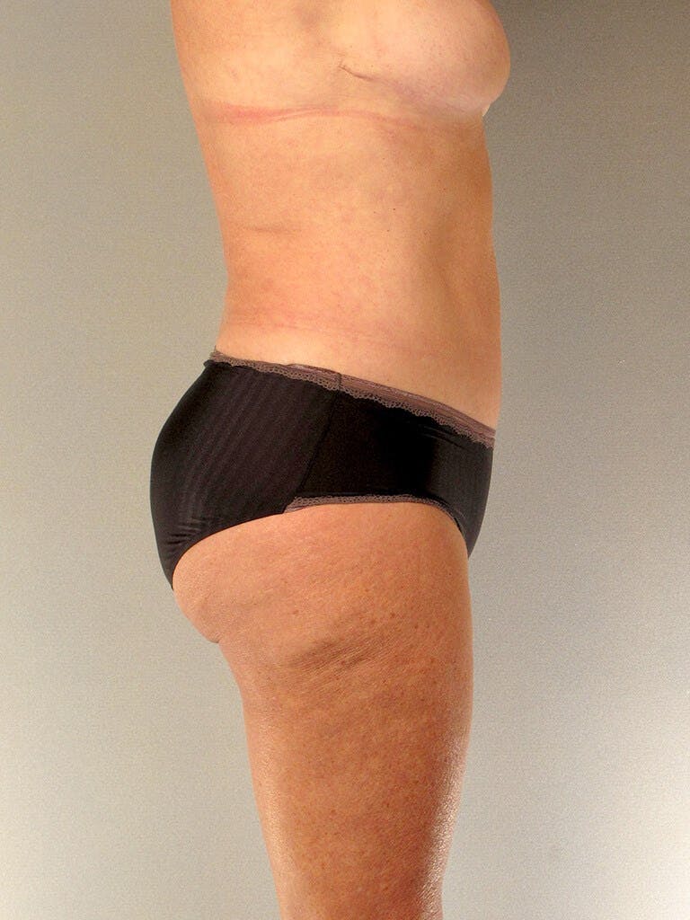 Tummy Tuck Before & After Gallery - Patient 275002 - Image 6