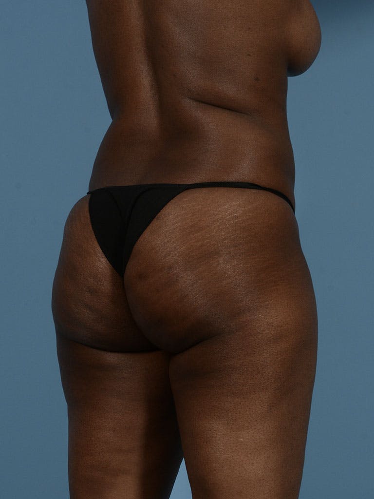Liposuction Before & After Gallery - Patient 372540 - Image 7