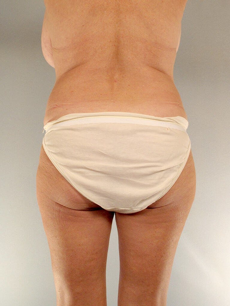 Tummy Tuck Before & After Gallery - Patient 275002 - Image 7