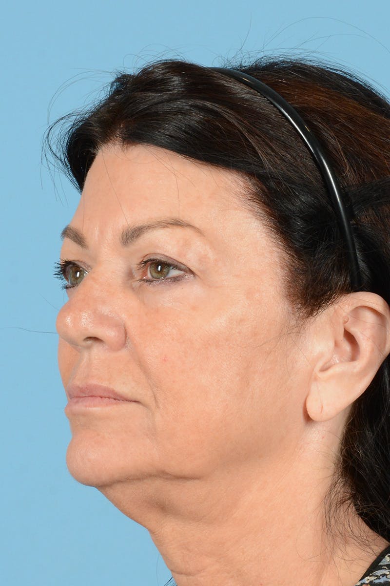Facelift Before & After Gallery - Patient 413115 - Image 7