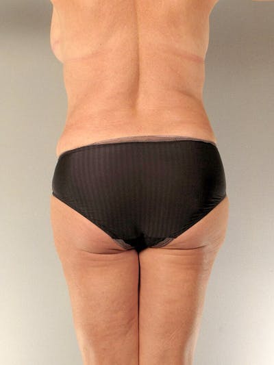 Tummy Tuck Before & After Gallery - Patient 275002 - Image 8