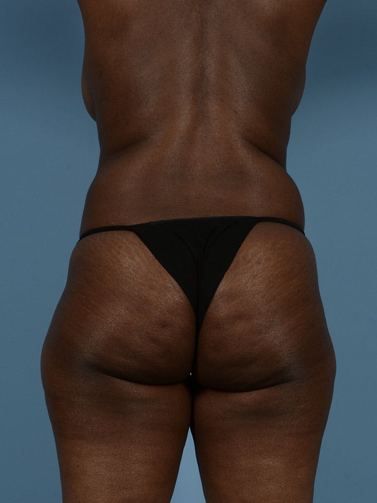 Liposuction Before & After Gallery - Patient 372540 - Image 9