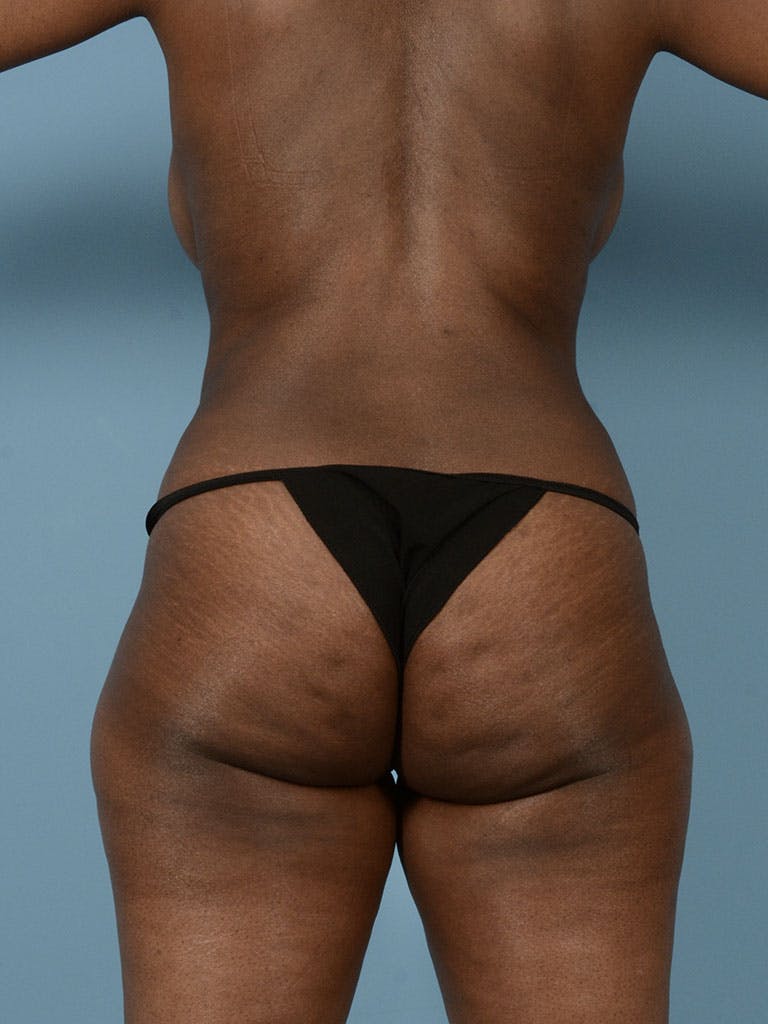 Liposuction Before & After Gallery - Patient 372540 - Image 10