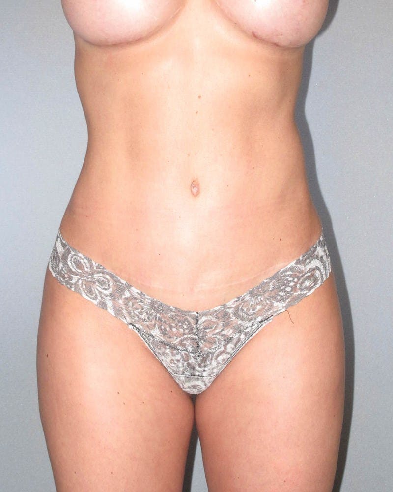 Tummy Tuck Before & After Gallery - Patient 282463 - Image 2