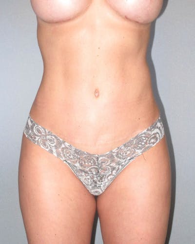 Tummy Tuck Before & After Gallery - Patient 282463 - Image 2