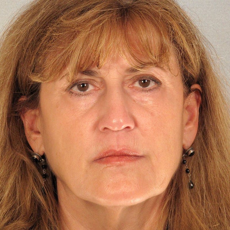 Eyelid Lift Before & After Gallery - Patient 107627 - Image 1