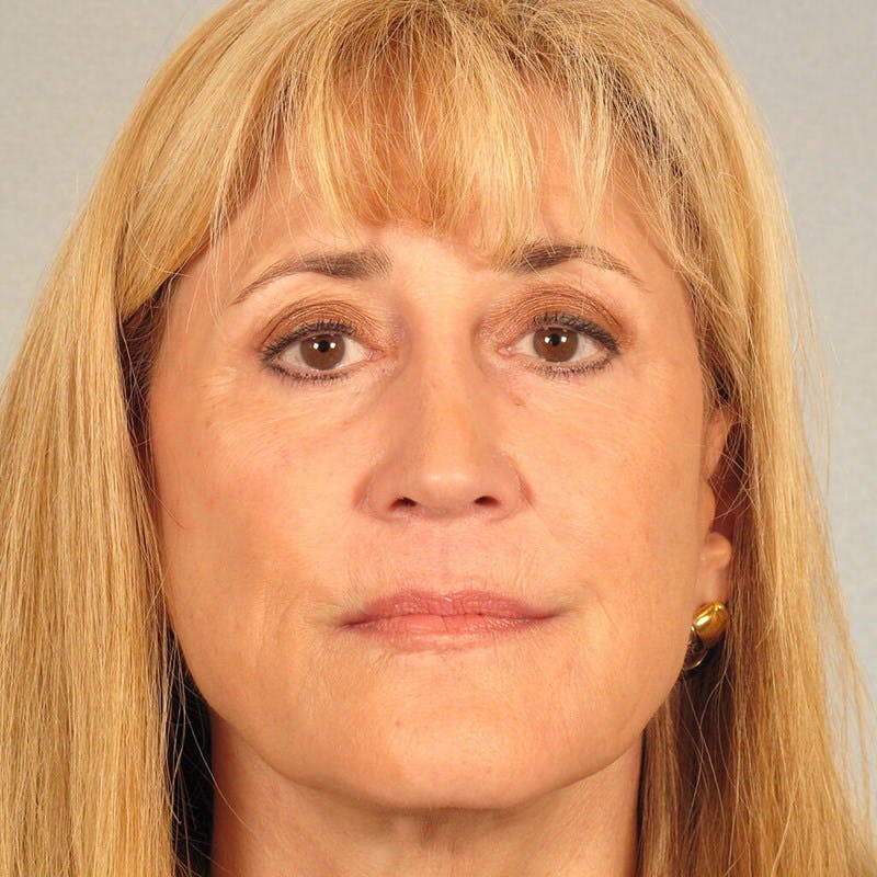 Eyelid Lift Before & After Gallery - Patient 107627 - Image 2
