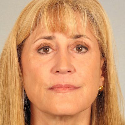 Eyelid Lift Before & After Gallery - Patient 107627 - Image 2