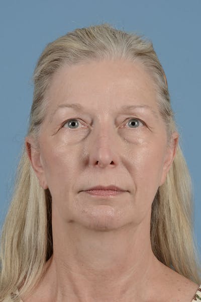 Facelift Before & After Gallery - Patient 168339 - Image 1