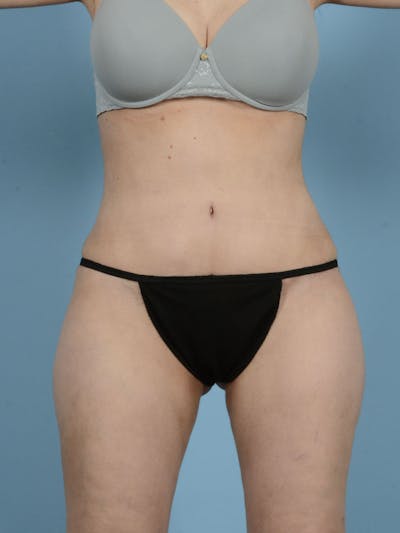 Liposuction Before & After Gallery - Patient 296496 - Image 2