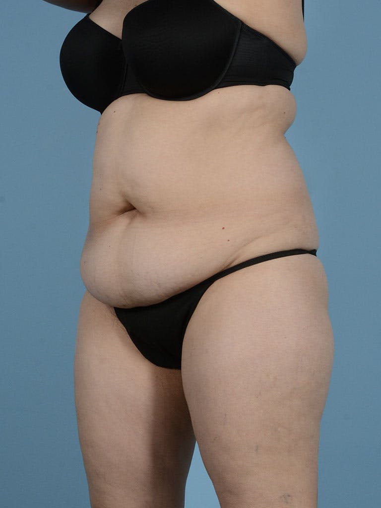Liposuction Before & After Gallery - Patient 296496 - Image 3