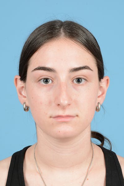Rhinoplasty Before & After Gallery - Patient 126984 - Image 1
