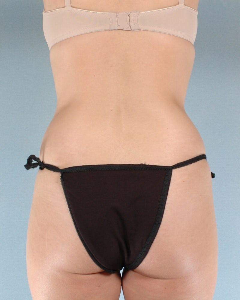 Tummy Tuck Before & After Gallery - Patient 282463 - Image 7