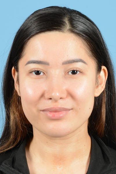 Fillers Before & After Gallery - Patient 255154 - Image 2