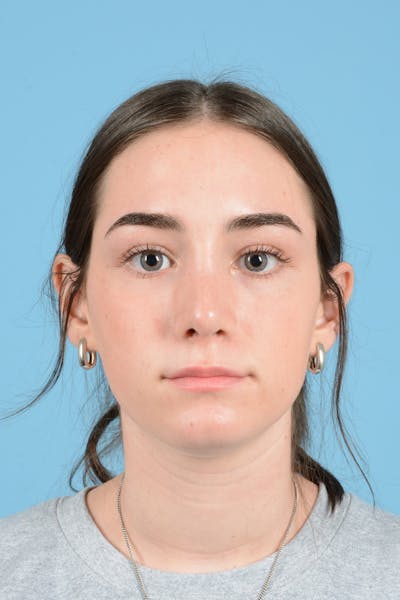 Rhinoplasty Before & After Gallery - Patient 126984 - Image 2