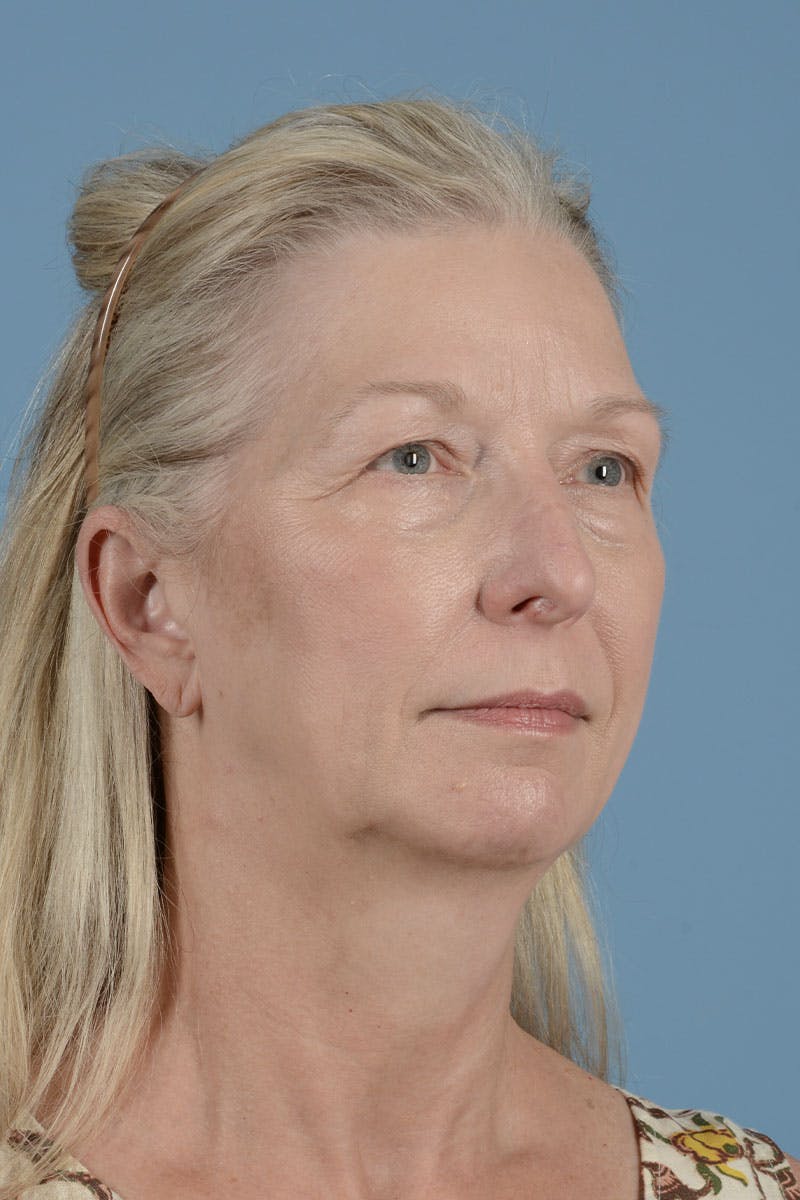 Facelift Before & After Gallery - Patient 168339 - Image 5