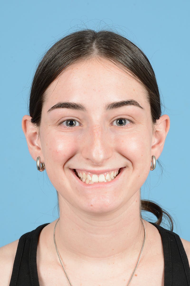 Rhinoplasty Before & After Gallery - Patient 126984 - Image 3